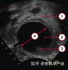 3. 优势卵泡超声图