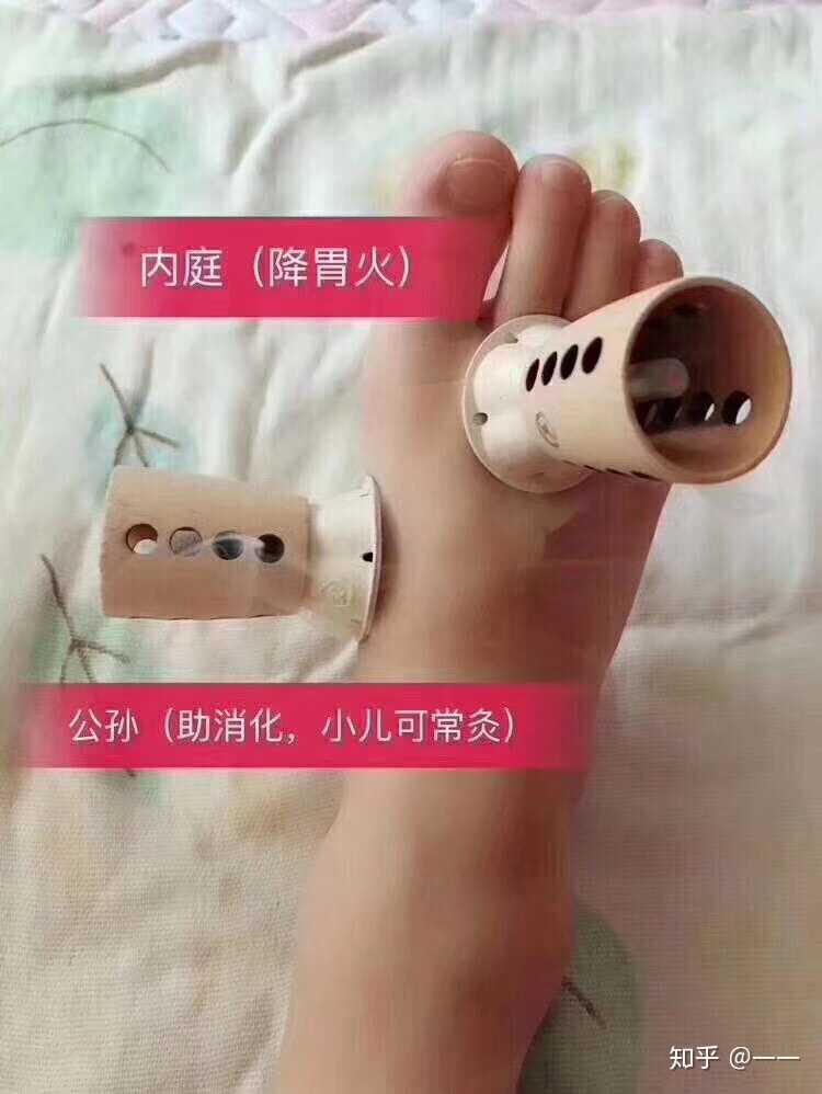 小孩子脾胃虚弱艾灸不错