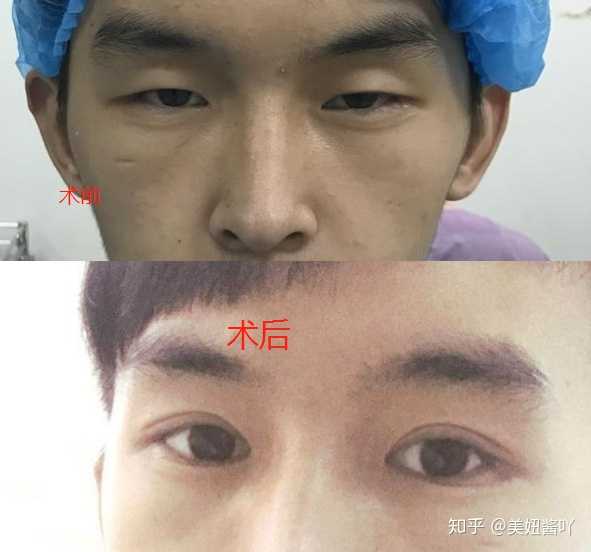 男生割双眼皮怎么看?