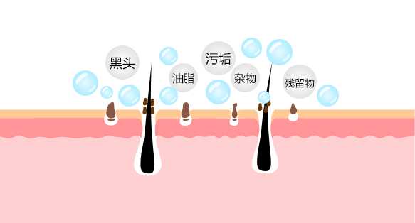 从自己身上扣下来最大的黑头有多大