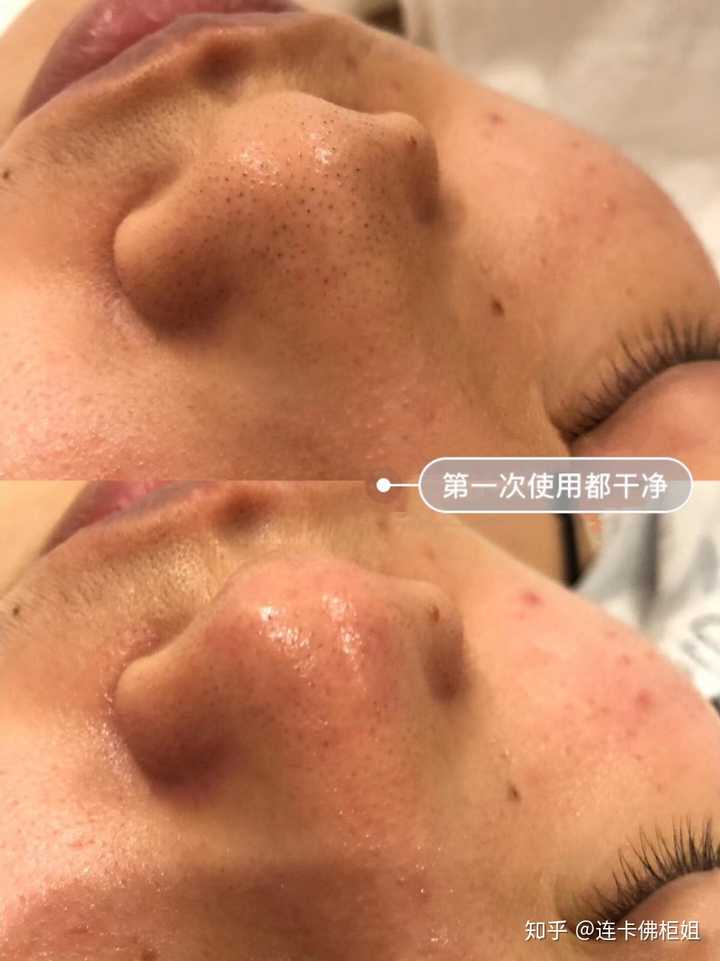 去黑头的最简便的方法?