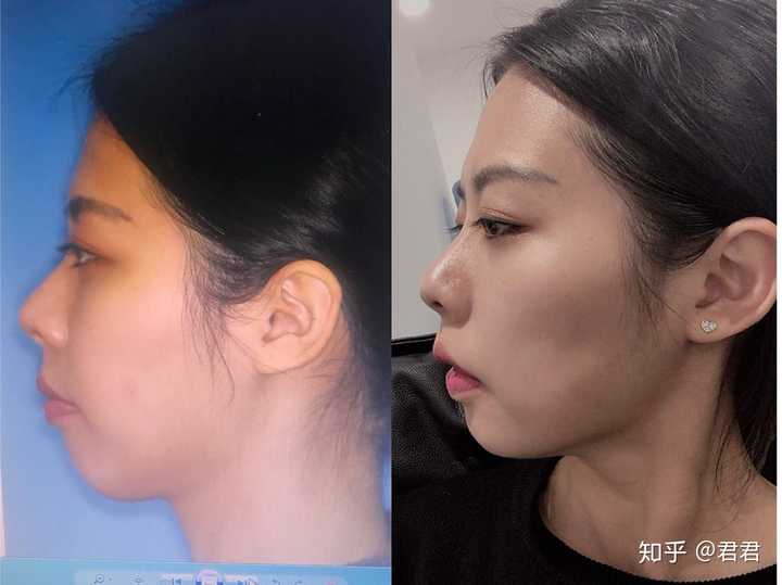 侧脸丑而正脸好看是一种什么体验?