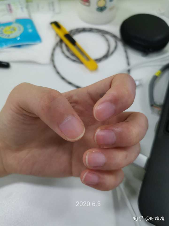 手指甲被咬的超级短怎么办?