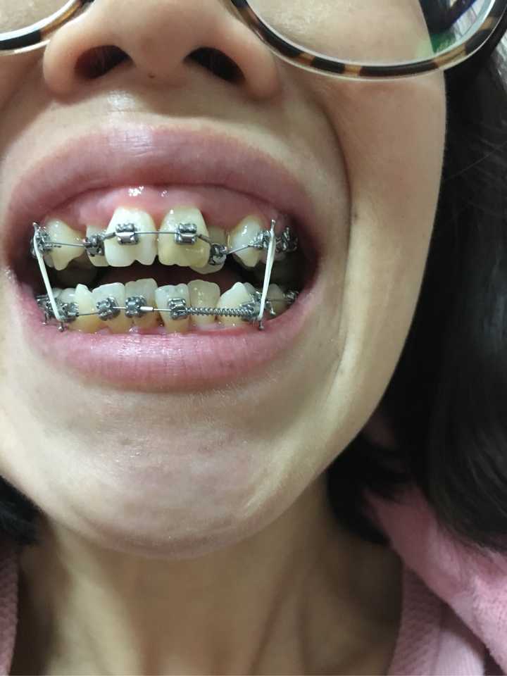 25 岁后去矫正牙齿(戴牙套)是什么体验?