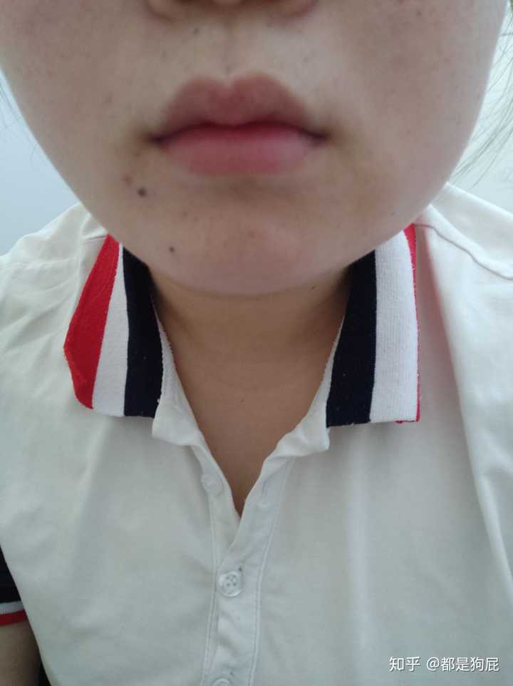 拔智齿脸肿?