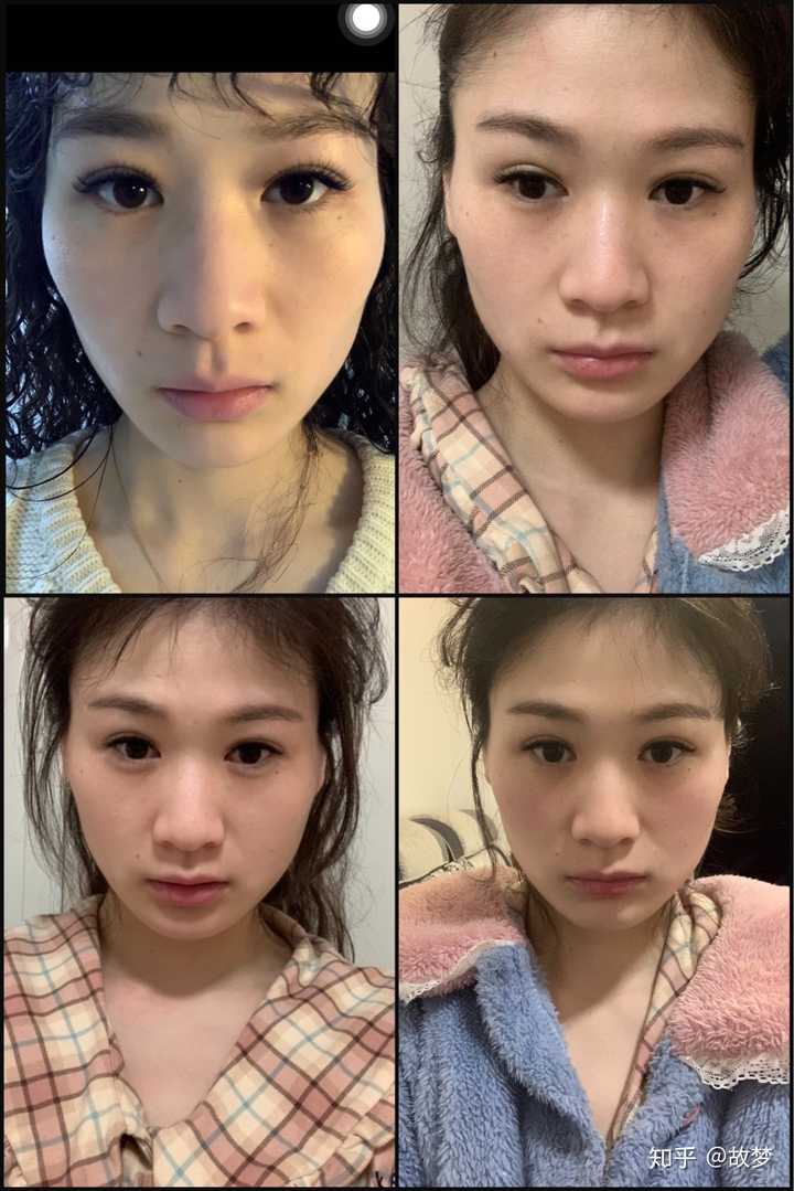 四个月的瘦颧骨确实是改善了,但是也导致我太阳穴凹陷严重了