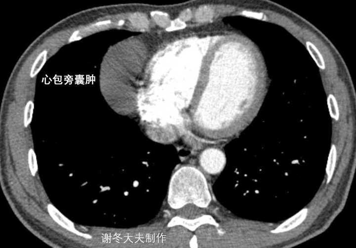 回答:这是一个 心包囊肿,不是胸腺瘤,但这个只能术中探查才能鉴别诊断