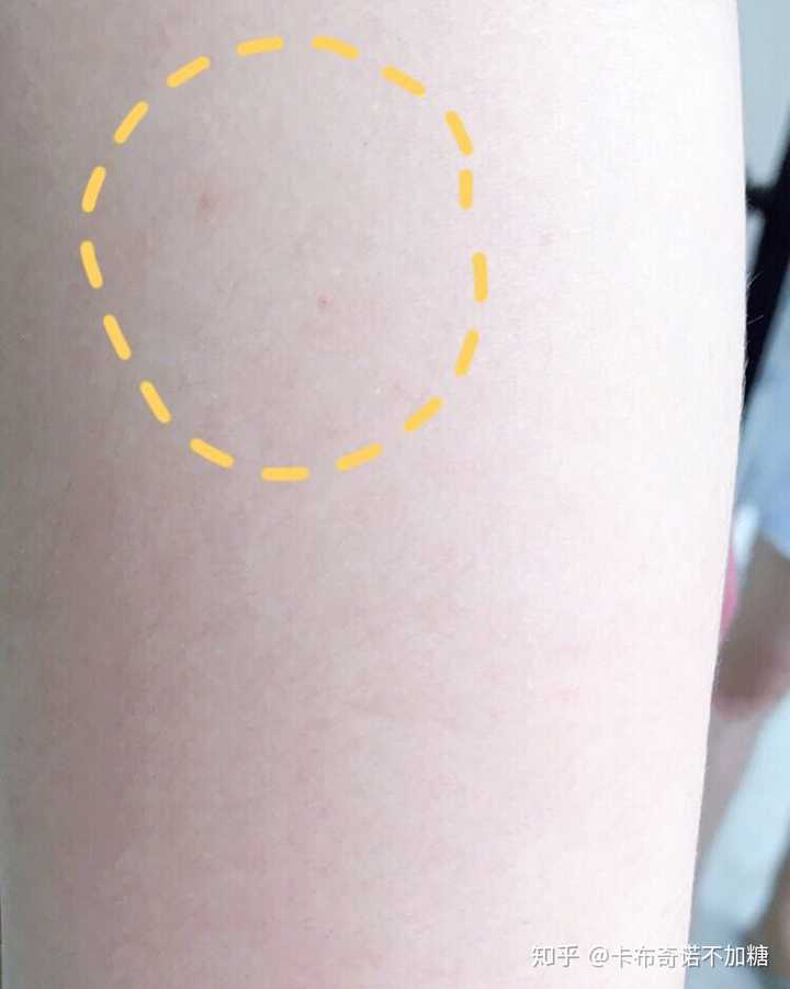 怎么样才能改善鸡皮肤?