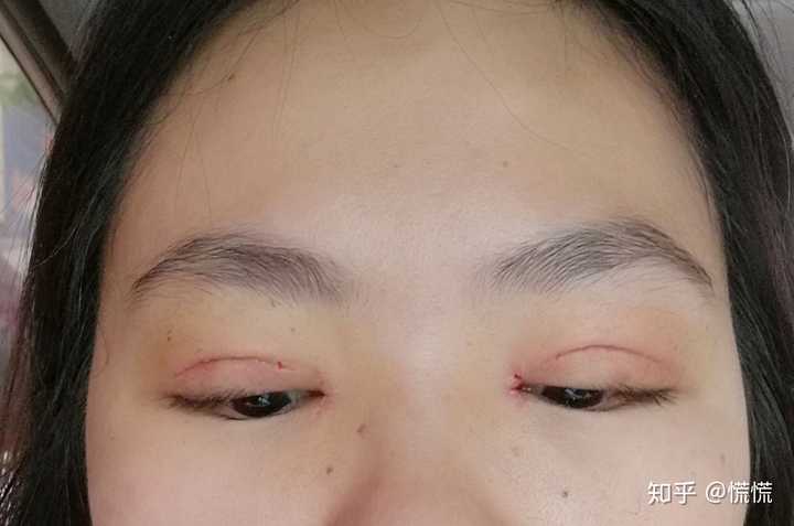 双眼皮拆线疼吗?