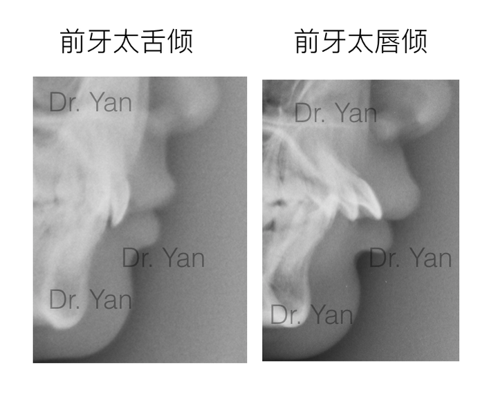 标准的牙齿咬合到底是什么样的?