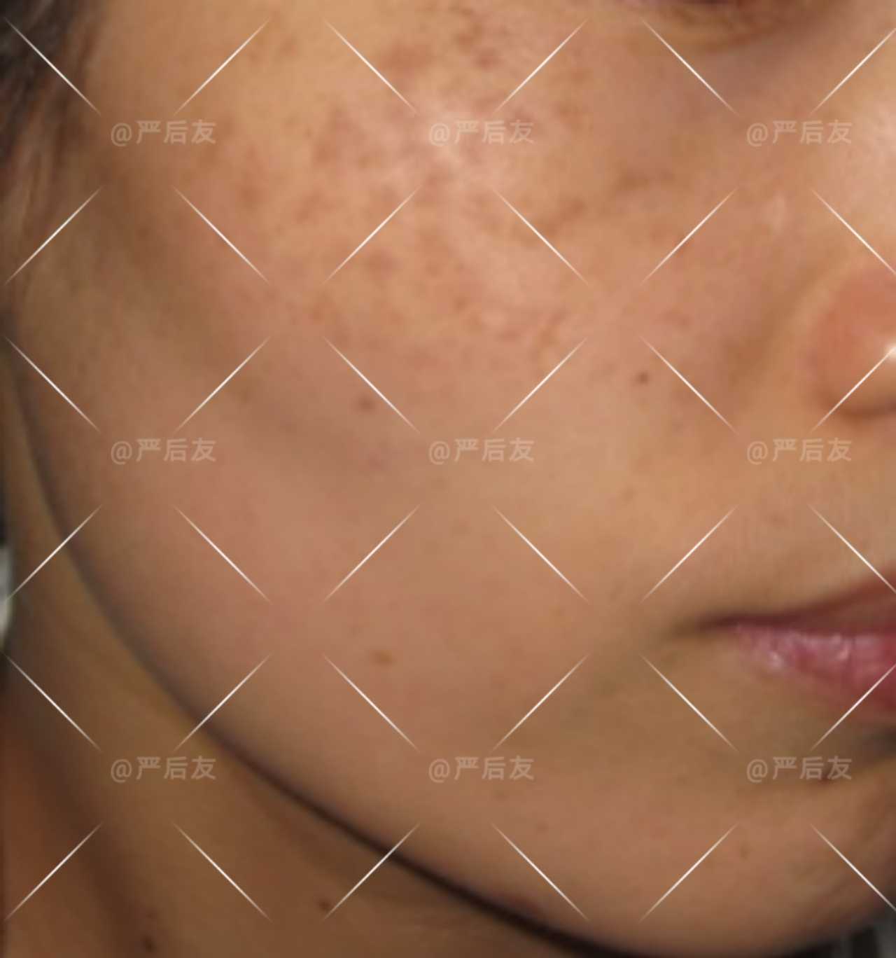 六次激光治疗后,颧骨褐青色痣(颧骨母斑消失)