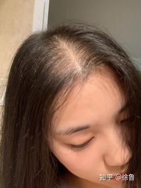 23岁女生狂脱发,怎么能快速生发?