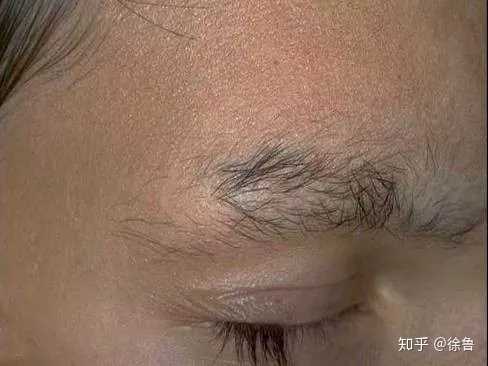 拔毛癖眉毛和睫毛部分被拔除