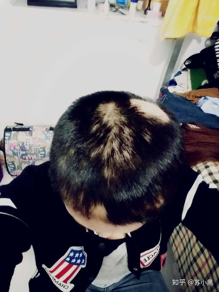 因为总掉头发,看着特别难受,所以一怒之下把头发给推掉了.