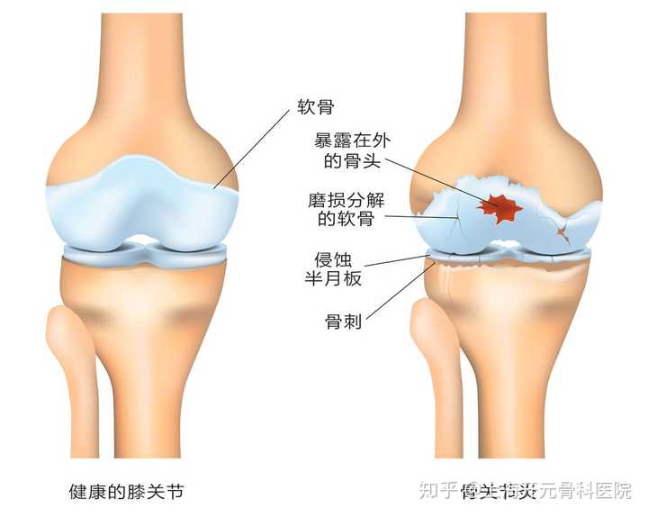 在膝盖上下关节骨交界的地方,骨头上面会覆盖着一层软骨,它就像一层