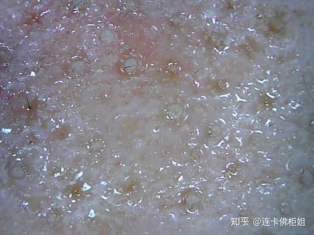 黑头这样了还有的救吗