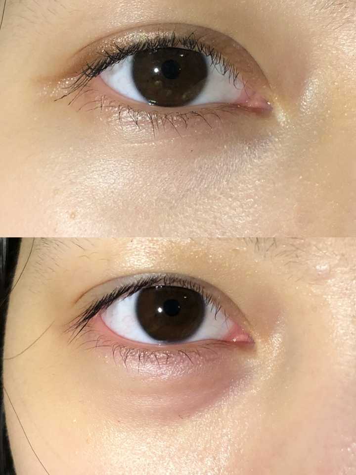 有没有 有卧蚕又有眼袋的人?