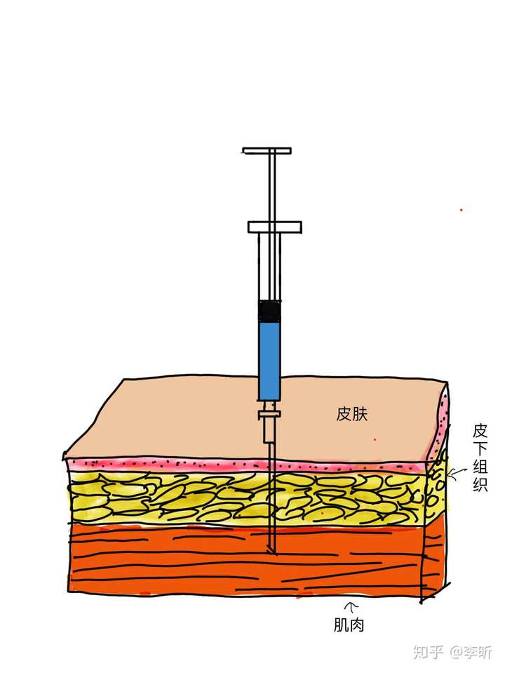 肌肉注射示意图