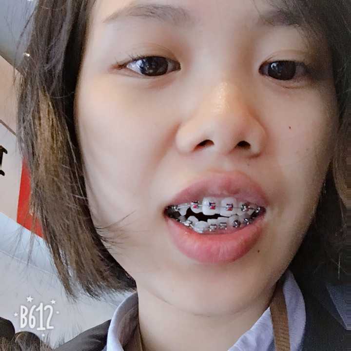 女生矫正牙齿后变美是怎样的体验?