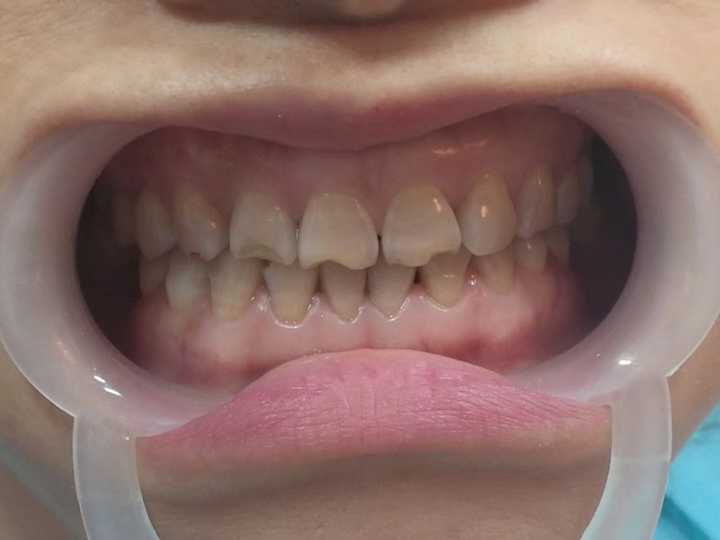 牙齿冷光美白适合哪些人群,对牙齿有什么伤害?