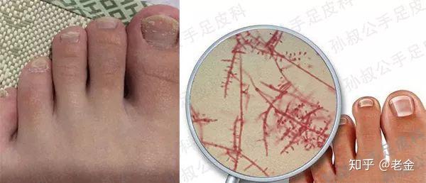 红色毛癣菌感染的指甲