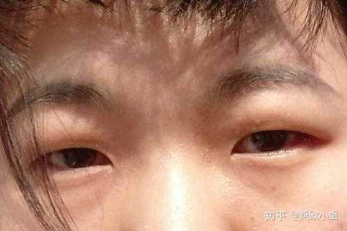 一般我们常见的眼部基础有以下几种 首先最常见的 肿泡眼(也叫金鱼眼