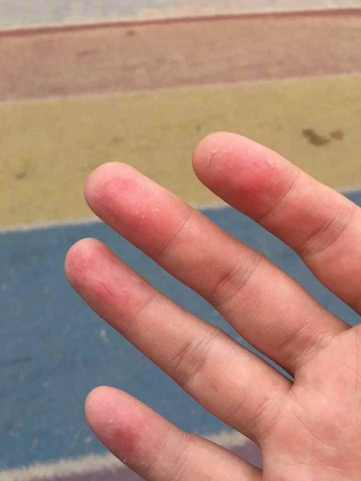 已经放弃治疗,先是红点然后开始奇痒无比,再后来会发现皮肤里有小水泡