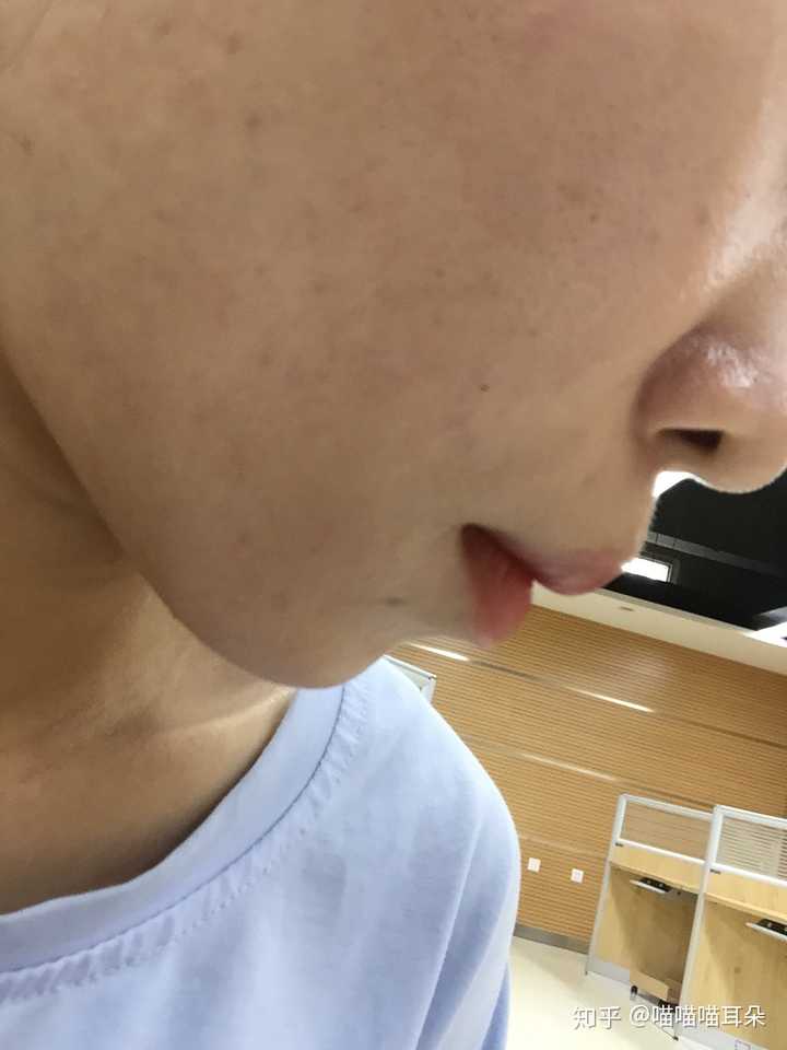 孔粗大的,凸嘴,塌鼻的我居然也有男朋友 再来张美颜后的侧面照