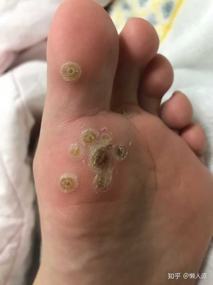 脚上感染长了疣,怎么弄.