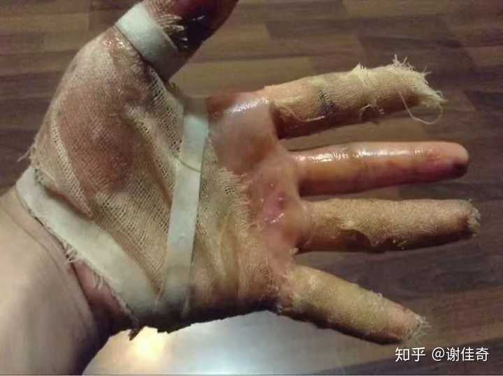 治疗一周,没拆纱布