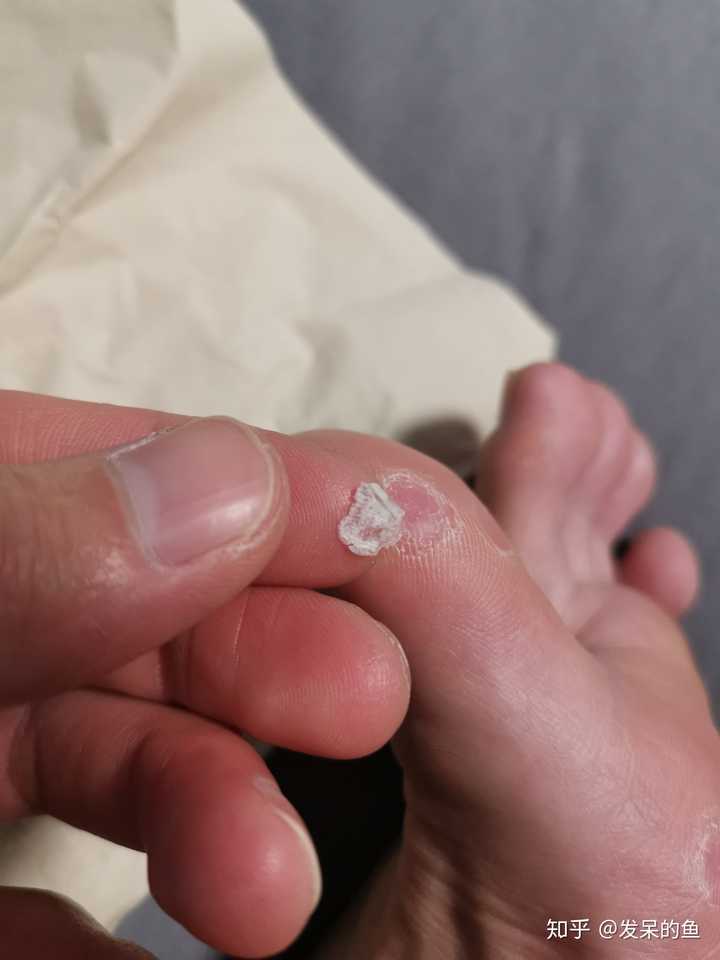 跖疣的自愈性大吗?
