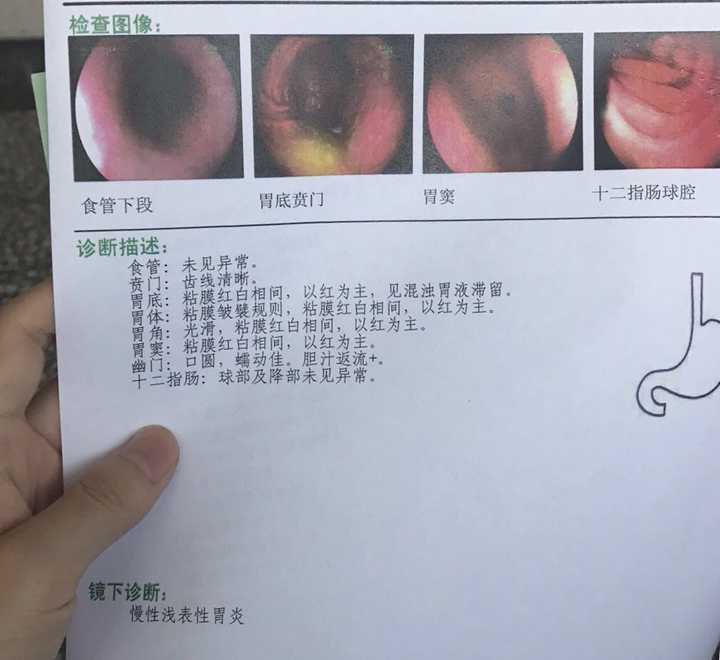 做胃镜是一种怎样的体验?