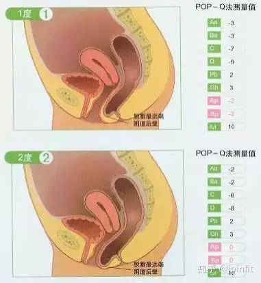 阴道前壁膨出图示↓ 阴道后壁膨出图示↓ 注:pop-q检查检查时, 以