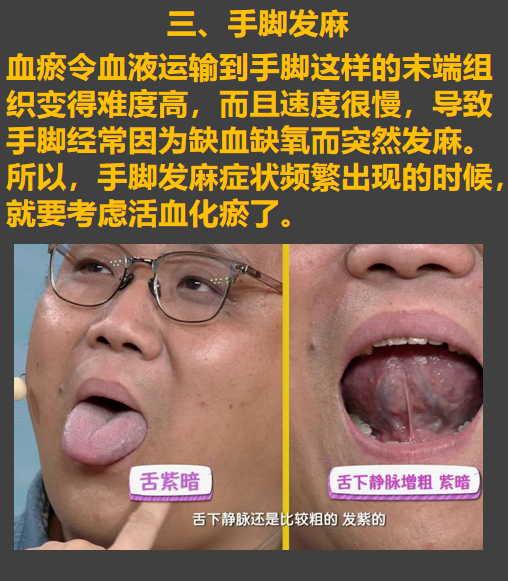 雷师兄健康 的想法 看舌下脉络知道自己是不是血瘀体质,如何