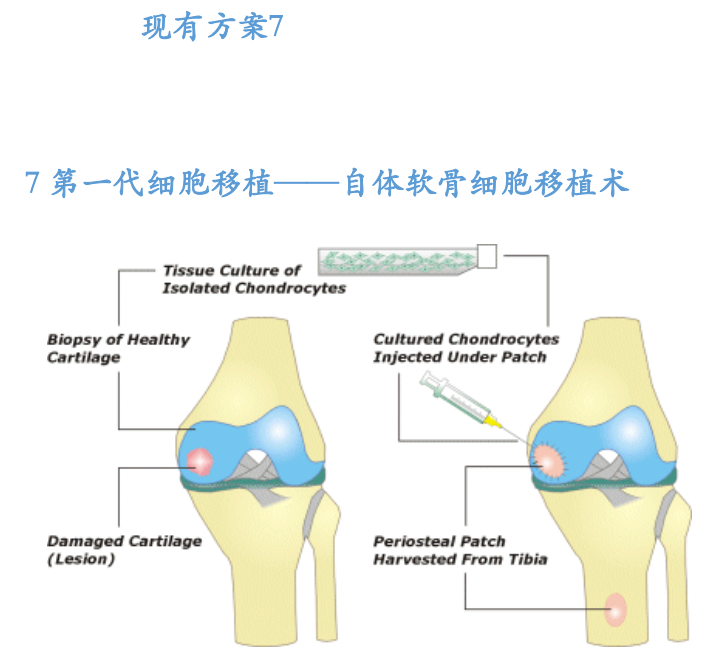 究其原因 1 关节软骨没有自我修复的能力 2 细胞不能迁移到缺损部位