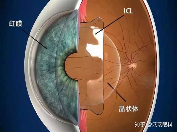 请问晶体植入手术治疗近视是否有后遗症?