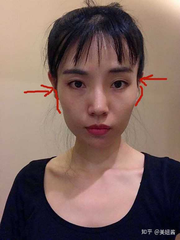 颧骨内推是怎样一种手术?