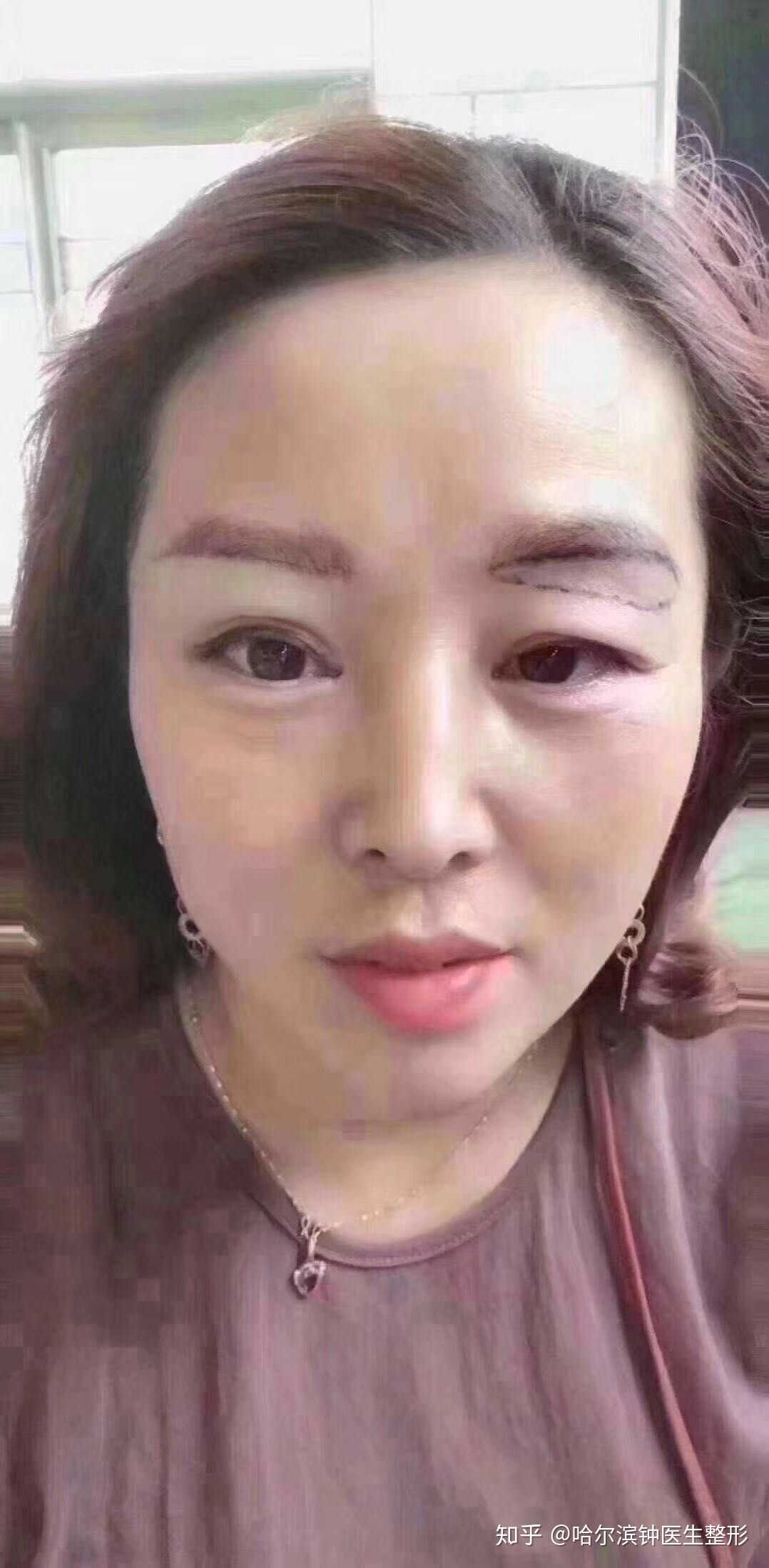 提眉介绍:是目前医学面部整形中惟一的"… - 知乎