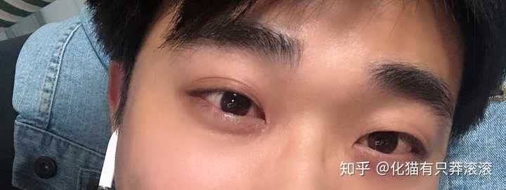 眼睛一大一小有什么影响?