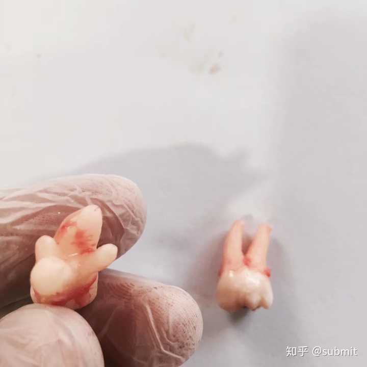 拔智齿有多痛?