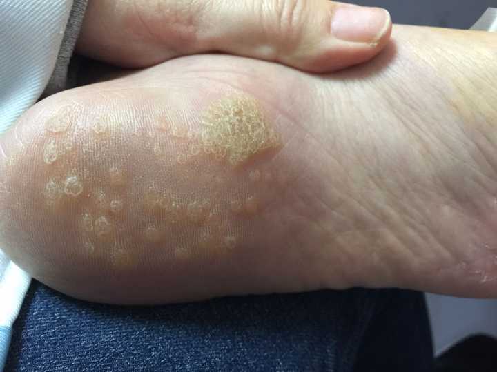 问题脚板,有小洞的?