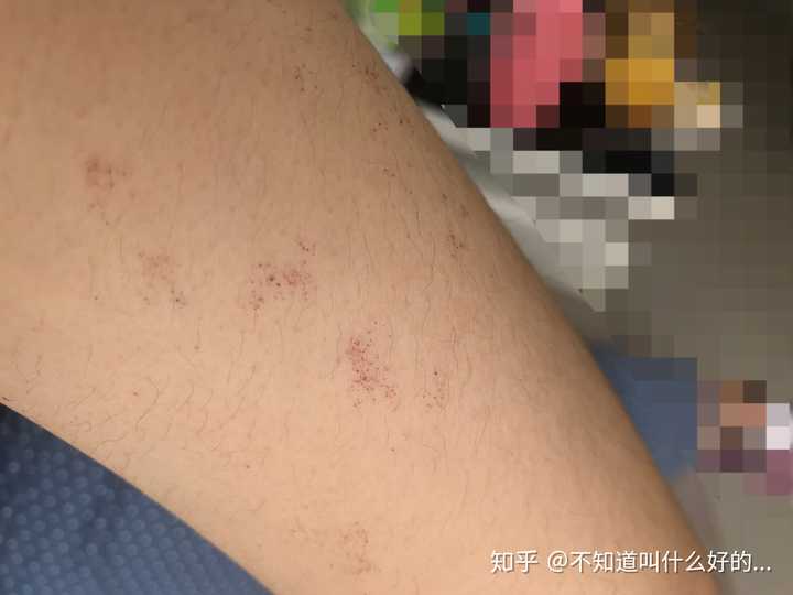 最近胳膊总是突然起这种红点点不疼不痒这是怎么回事?