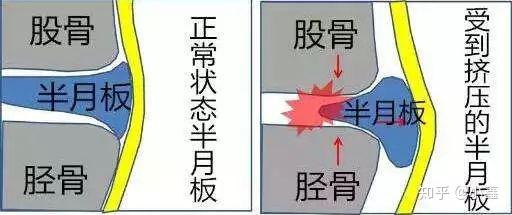 左膝关节腔及髌上囊内少量积液,半月板和韧带没啥问题