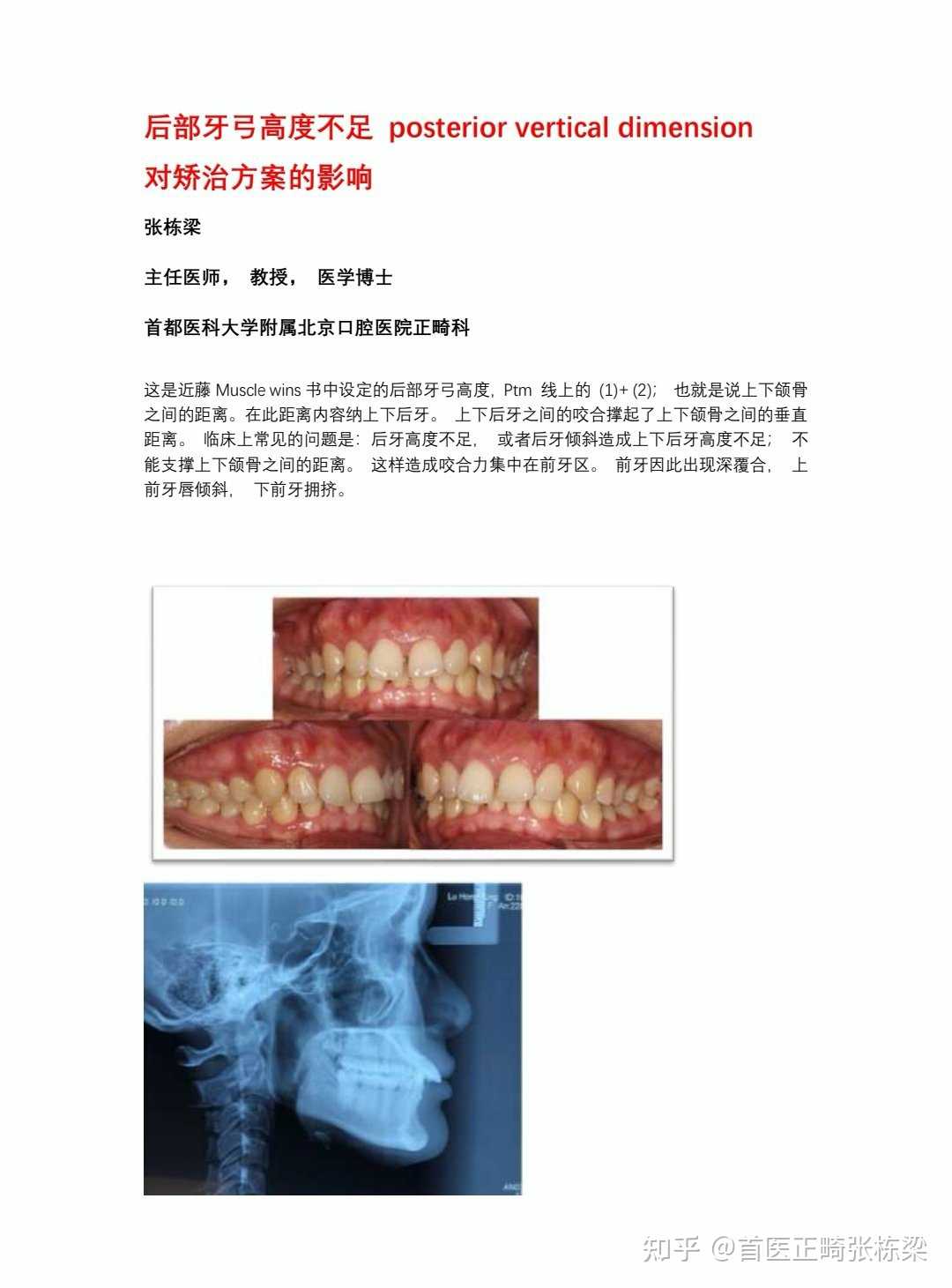 首医正畸张栋梁 的想法: 后部牙弓高度不足对矫治方案