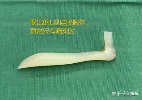 大家都知道l型假体已经被淘汰了,现在都是i型(柳叶型). 但是!