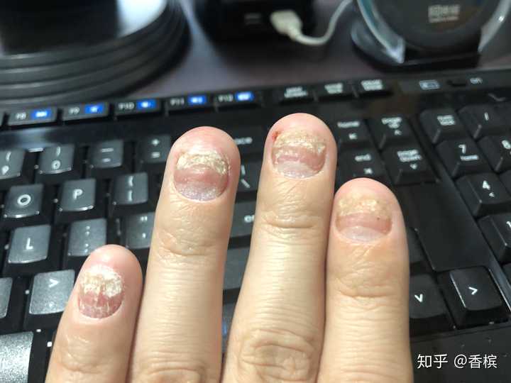 指甲型银屑病,十个指甲九个这样了,哎,一年多了,一直苦苦等待着治愈的