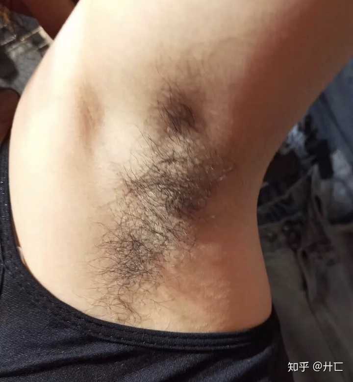 女生应该留腋毛吗,怎么处理比较好呢?