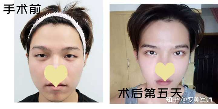 男生做双眼皮手术是什么体验?