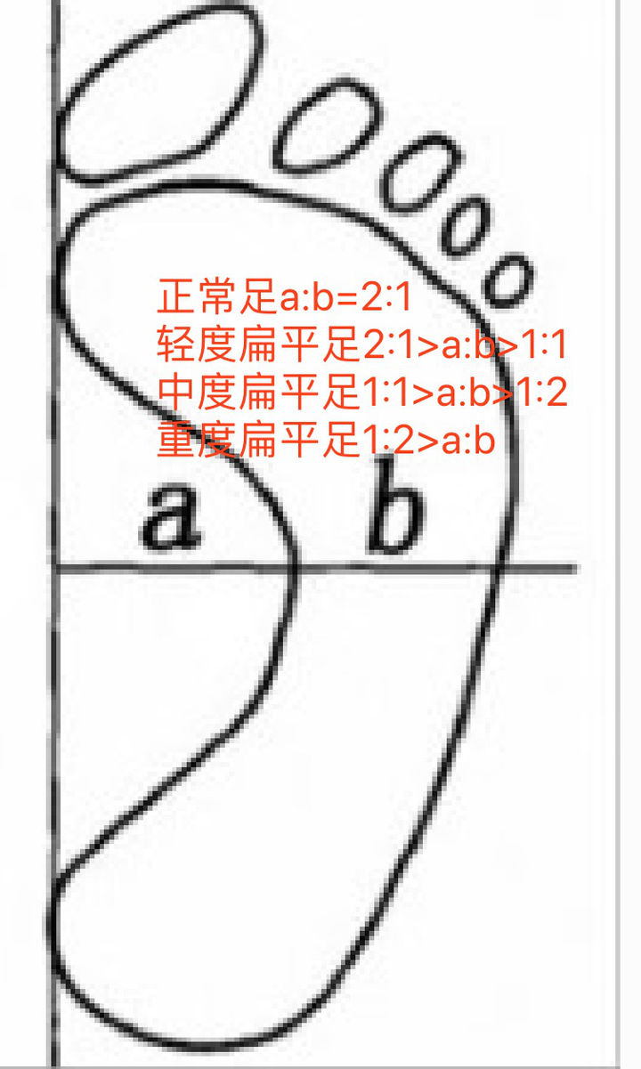 如何有效矫正扁平足