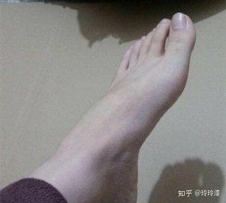 女生有脚气是怎样一种体验?